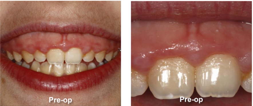 Gingivectomy And Maxillary Frenectomy